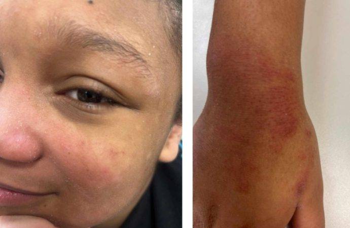 Mother Seeks Answers After Nonverbal Student Suffers Unexplained Injuries at Redford Middle School